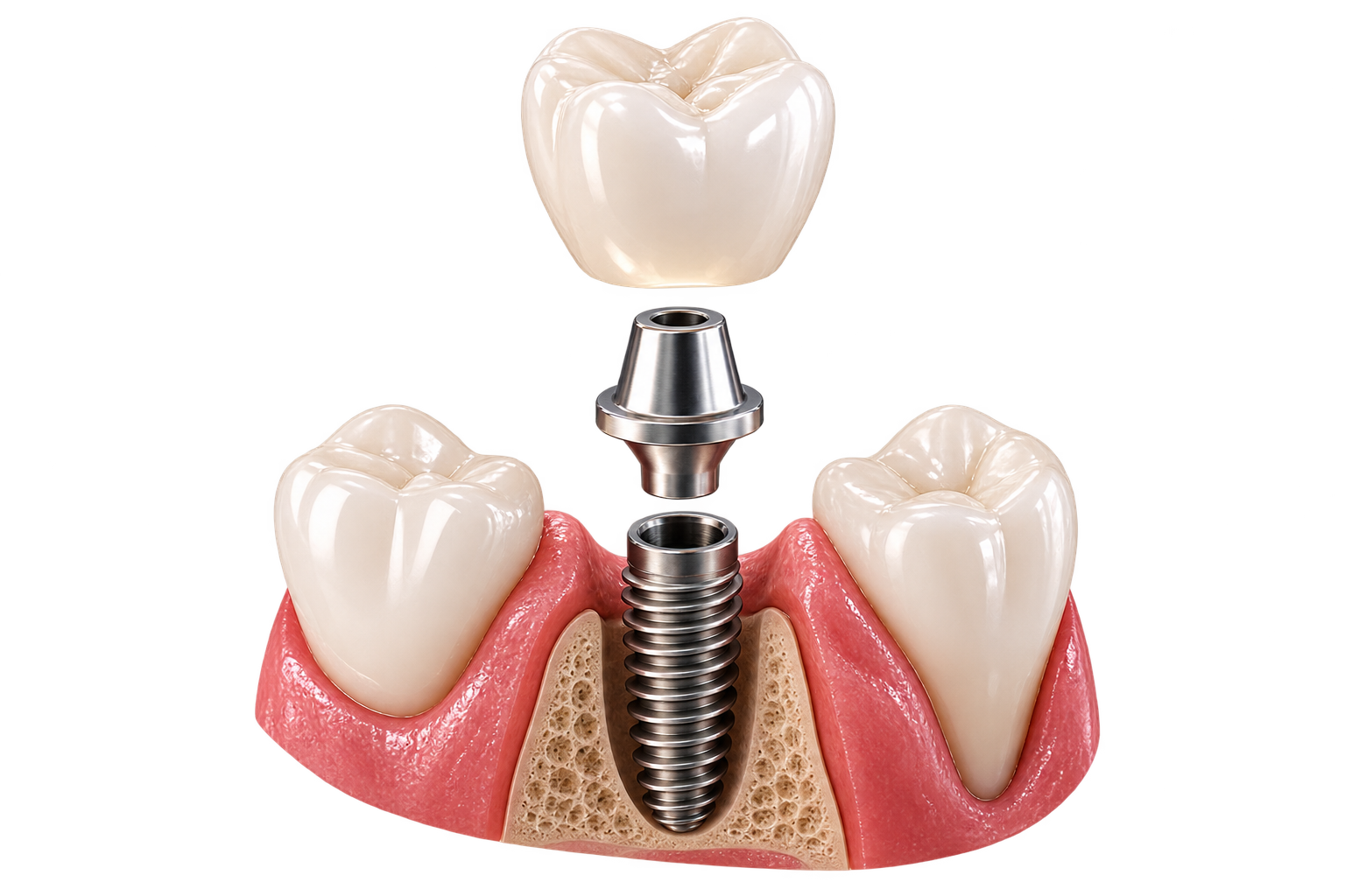 Dental Implants & Restorative